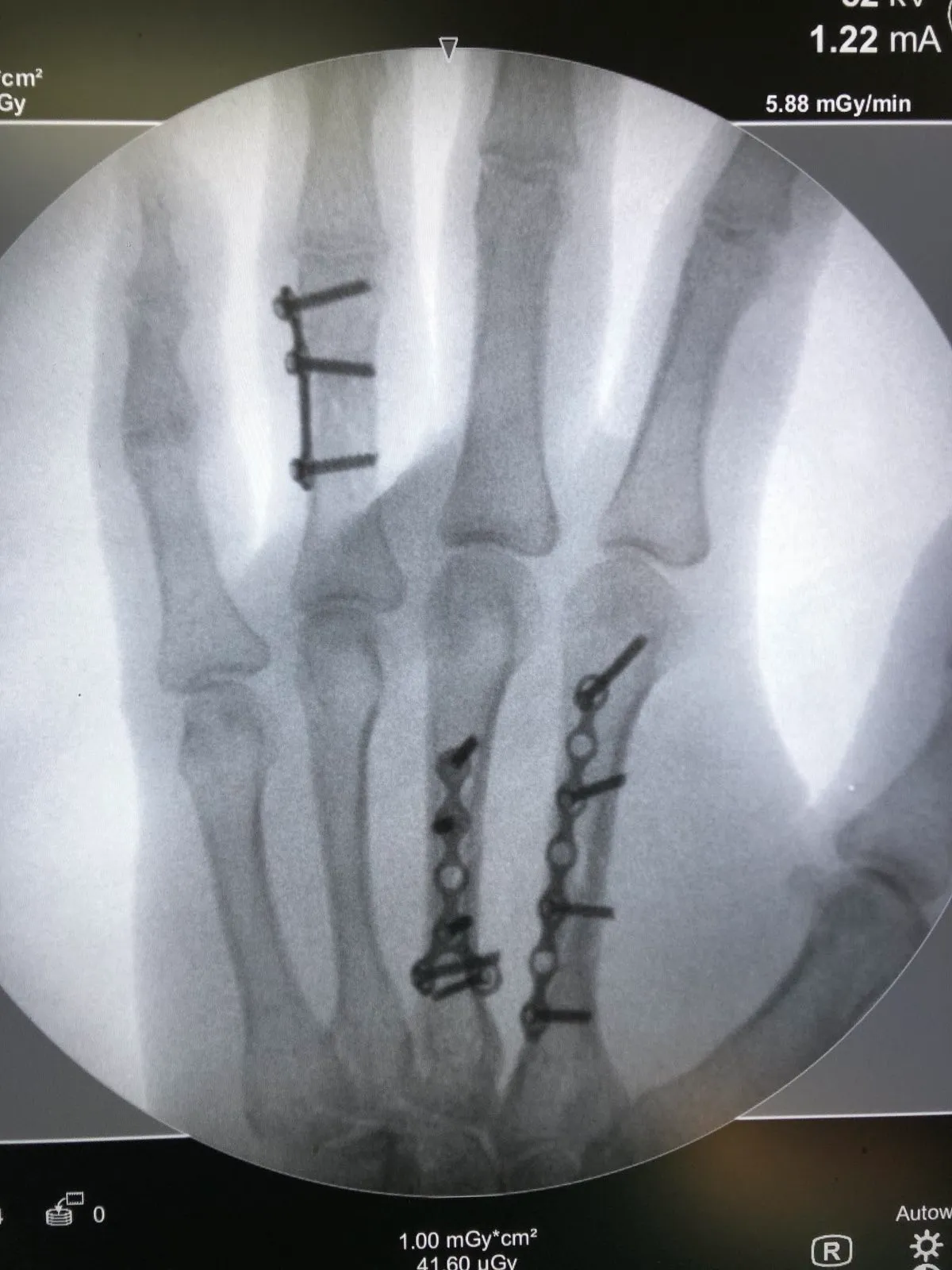 Репозиция и фиксация переломов